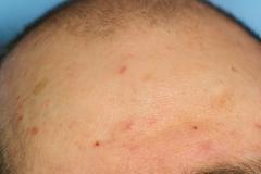 Remove acne in Photoshop